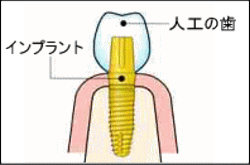 福岡市南区 インプラント1