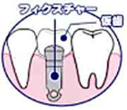 福岡市南区 インプラント3