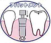 福岡市南区 インプラント4